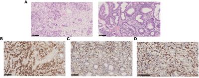 Case report: A case of rare metastasis of gastric cancer to the axillary lymph node metastasis treated with combination immunotherapy